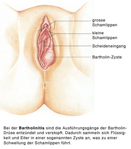 Bartholin-Zysten - Gesundheitsprobleme von Frauen - MSD Manual Ausgabe für  Patienten