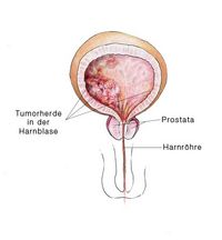 Blasenkarzinom, Blasenkrebs, Blasentumor, bösartiger Blasenkrebs