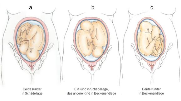 Die drei häufigsten Kombinationen der Kindslagen von Zwillingen in der Gebärmutter, Lage von Zwillingen, Anordnung in der Gebärmutter