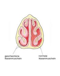 Schnupfen, vasomotorische Rhinitis, Veränderunge der Nasenmuscheln bei Schnupfen