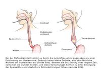 Speiseröhrenverengung, Speiseröhrenentzündung