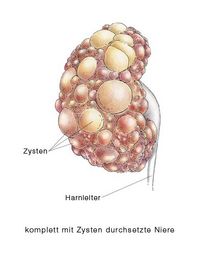 Zystenniere, Zystennieren