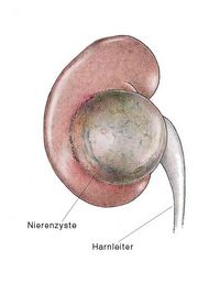 Nierenzyste, Nieren-Zyste, Zyste an der Niere