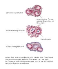 Stimmbandgranulom