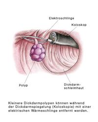 Endoskopischer Eingriff zur Entfernung eines Dickdarmpolypen, Endoskopie