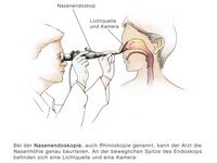 Nasenendoskop, Spiegelung der Nase bei Verdacht auf eine Nasenseptumperforation