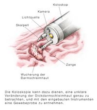 Koloskopie zur näheren Betrachtung von Veränderungen auf der Dickdarmschleimhaut und zur Entnahme von Gewebeproben, Endoskopie, Untersuchung des Dickdarms