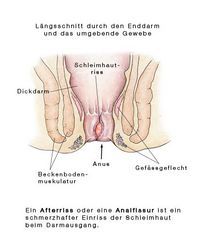 Afterriss, Analfissur