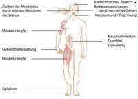 Beschwerden bei einer Unterfunktion der Nebenschilddrüsen, Symptome bei einer Unterfunktion der Nebenschilddrüsen