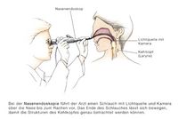 Nasenendoskopie, Rhinoskopie bei Stimmbandknötchen