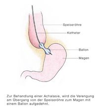 Achalasie Therapie