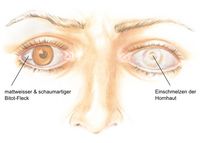 Bitot-Fleck der Augenbindehaut & Einschmelzung der Hornhaut, Beschwerden bei Vitamin A-Mangel, Symptome bei Vitamin A-Mangel