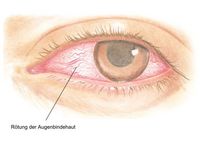 Rötung der Bindehaut eines Auges, Symptome bei einer Nebenschilddrüsenunterfunktion