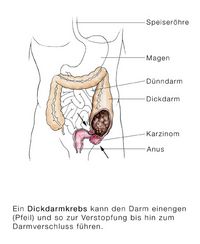 Dickdarmkrebs mit Darmverschluss