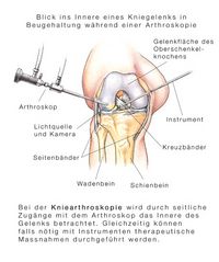Arhtroskopie des Kniegelenks, endoskopische Untersuchung des Kniegelenks, Diagnose