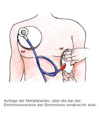 Therapie Elektrokonversion beim Vorhofflimmern