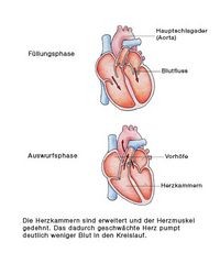 Dilatative Kardiomyopathie