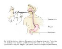 Endoskopische Untersuchung von Speiseröhre und Magen