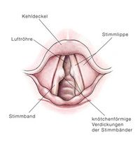 Stimmbandknötchen, Verdickungen der Stimmbänder, Sängerknötchen, Schreiknötchen