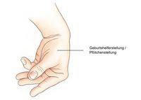 Pfötchen- oder Geburtshelferstellung der Hand, Symptome einer Nebenschilddrüsenunterfunktion