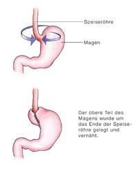 Chirurgische Therapie bei Reflux