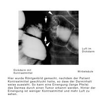 Darmtumor Röntgenbild