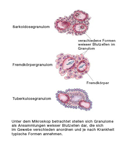 Morbus Wegener Wegener Granulomatose Bilder