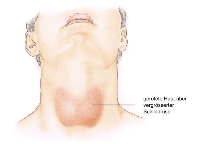 Schilddrüse schmerzen hals Halsschmerzen bei