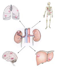 Metastasen beim Nierenzell-Karzinom